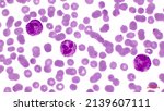 Light micrograph of human blood cells, showing numerous red cells (erythrocytes) and three neutrophils (white cells) with segmented nucleus. Magnification - 1000.