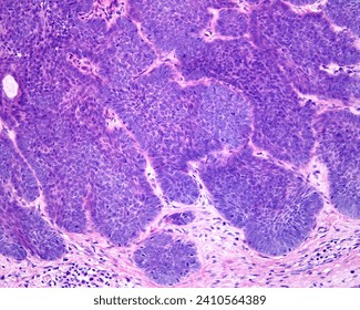 Light micrograph of human skin showing an ulcerated basal cell carcinoma (BCC). The intense proliferative activity of epidermal basal keratinocytes forms lobular structures that invade the dermis.