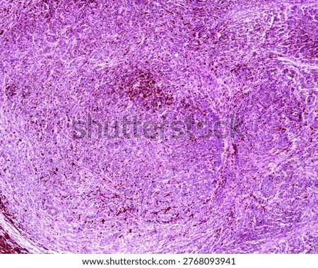Light micrograph of a melanoma, the deadliest of all skin cancers, which is strongly linked to acquired mutations caused by exposure to UV (ultraviolet) radiation in sunlight. The tumour is formed by strands of spindle-shaped malignant cells with cytological atypia, pleomorphism, sheet-like growth and proliferative activity and variable amounts of melanin.