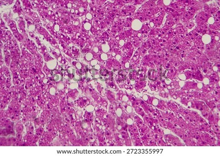 Light micrograph revealing liver tissue with fatty infiltration, indicative of hepatic steatosis or fatty liver disease.