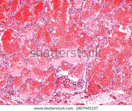 Light micrograph of a section of a human lung affected by a haemorrhage. The alveoli are dilated and their lumina is occupied by accumulations of extravasated blood cells.