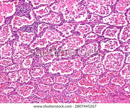 Light micrograph of a section of a human lung showing consolidated alveoli. The lumen of the alveoli is occupied by fluid (oedema) which contains red blood cells and many macrophages. This aspect appears in the resolution of alveolar haemorrhages.
