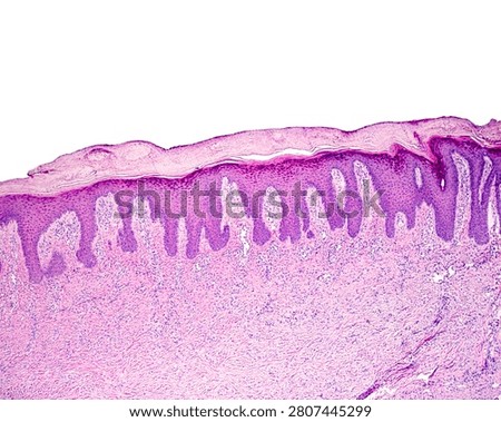 Light micrograph of a section through human skin with lichen planus. It shows hyperkeratosis (top), acanthosis (dark purple) and long dermal papillae (finger-like) occupied by a chronic inflammatory infiltrate rich in lymphocytes.