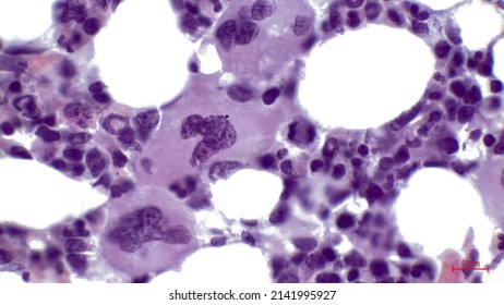 Light Micrograph Of A Section Through Red Bone Marrow Tissue. It Consists Mainly Of Haematopoietic Tissue, Where Blood Cells Are Created. In The Center Are Three Megakaryocytes.