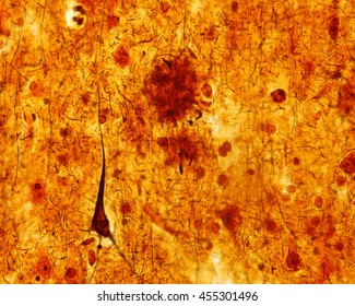 Light Micrograph Of A Senile Plaque Stained With A Silver Impregnation. A Pyramidal Neuron With A Neurofibrillary Tangle Also Can Be Seen. Both Alterations Are Seen In The Alzheimer Disease.
