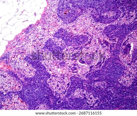 Light micrograph showing a human lymph node almost completely invaded by cancer cells of a squamous cell carcinoma of the mouth. The lymph node sinuses are enlarged and full of cancerous cells.