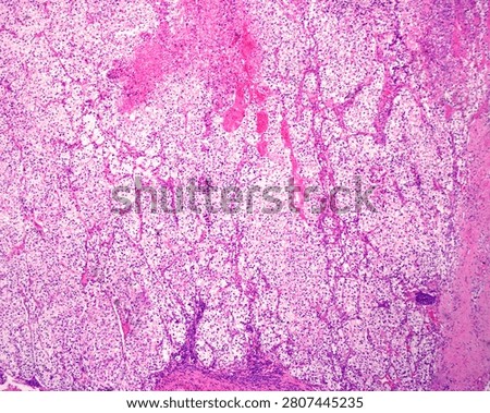 Light micrograph showing a renal clear cell carcinoma (also known as hypernephroma or tumour of Grawitz), the most common renal epithelial tumor. Malignant epithelial cells with clear cytoplasm and a solid acinar growth pattern interspersed with intricate, thin-walled capillary network. These cells are clear due to the abundance of intracytoplasmic lipids as well as glycogen.