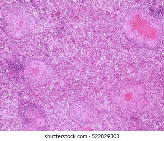 Light Micrograph Of A Spleen Of A Person With Advanced Tuberculosis. Several Typical Granulomas With A Central Necrosis (caseous Necrosis) Can Be Seen.