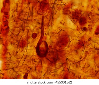 Light Microscope Micrograph Of A Senile Cerebrum, Stained With A Silver Method, Showing A Neuron With A Neurofibrillary Tangle, An Injury Frequently Seen In The Alzheimer Disease.