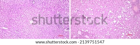Light microscopy of the liver. Comparison of the structure (histology) of a healthy human liver (left) and the liver affected by Fatty disease (right). Hematoxylin and eosin stain.
