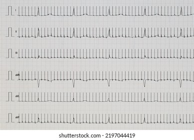 Limb Leads Of An ECG Overlaid With Pulses From An Intestinal Pacemaker