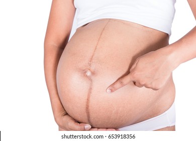 Linea Nigra And Stretch Marks On Pregnant Women