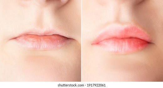 Lip augmentation before and after close up. Woman lips surgery, filler injection, mesotherapy, correction.