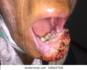 Lip Cancer, Malignancy Neoplasm Of Oral Cavity. Smoking And Alcohol Drinking Are Risk Factor. Large Cancer.