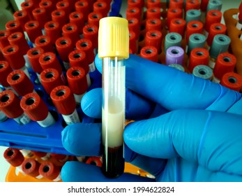 Lipemic Serum Blood Sample Tube Holding By Medical Technologist. To Estimate Triglyceride, Lipid Profile, Cholesterol And Cardiac Marker Of A Patient At Medical Laboratory For Heart Function.