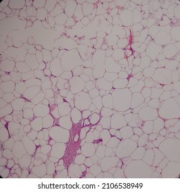 Lipoma, benign growth of fatty tissue, benign neoplasm, adipocytes, partially capsulated tumor, 40x microscopic view.