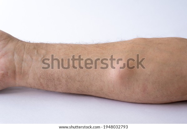 Lipoma, a benign neoplasm, a tumor on\
the forearm of a Caucasian man on a white\
background.