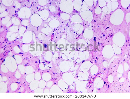 Liposarcoma of a human, photomicrograph panorama as seen under the microscope, 200x zoom.