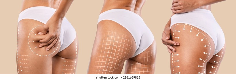 Liposuction Concept. Set Of Female Buttocks With Lifting Up Lines On It, Unrecognizable Fit Woman In White Panties Demonstrating Tight Skin On Hips, Standing Isolated Over Beige Background, Collage