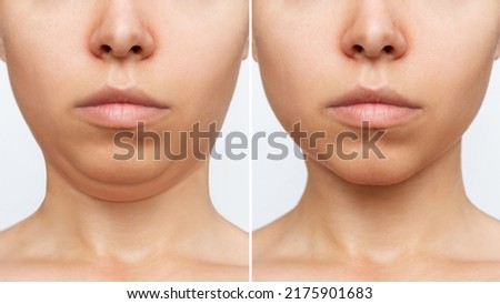 Liposuction of the double chin. Cropped shot of a woman's face with chin before and after cosmetic plastic surgery isolated on a white background. The result of lifting, fat removal, weight loss