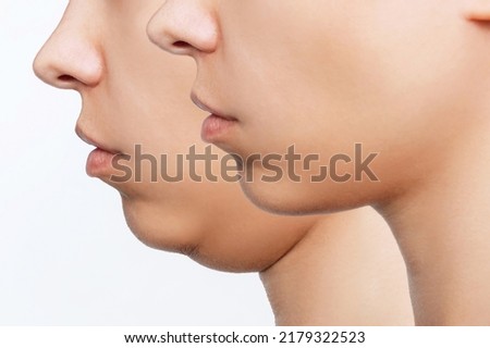 Liposuction of double chin. Cropped shot of woman's face with chin before and after cosmetic plastic surgery isolated on a white background. The result of lifting. Fat removal, weight loss. Profile