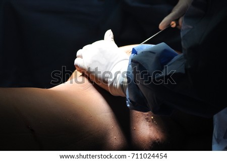 Liposuction surgery