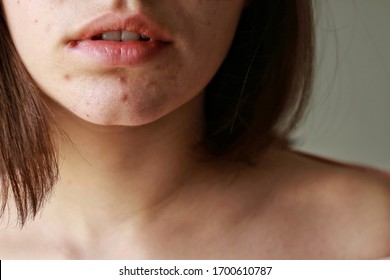 Lips Of A Girl. Acne On The Chin. Acne Problem
