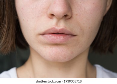 Lips Of A Girl. Acne On The Chin. Acne Problem