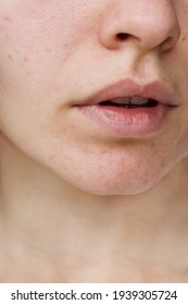 Lips Of A Girl. Acne On The Chin. Acne Problem