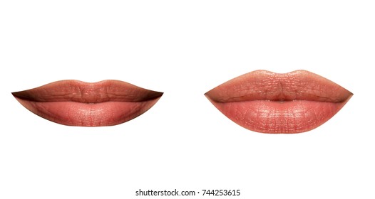 Lips of woman thin and full, set. Plastic lip correction. Botox and hyaluronic acid. Injections of youth, injections for the volume of lips. Girl made her lips big, beauty and makeup
