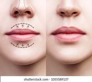 Lips of young woman before and after augmentation