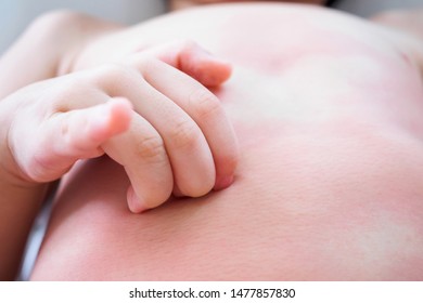 Little Asian Baby Girl Hand Scratch On Her Body With Skin Rash Itchy And Allergy