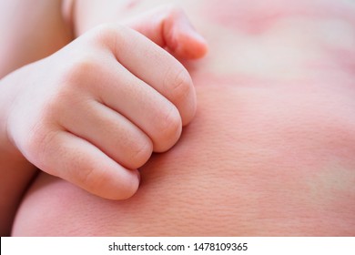 Little Asian Baby Girl Hand Scratch On Her Body With Skin Rash Itchy And Allergy