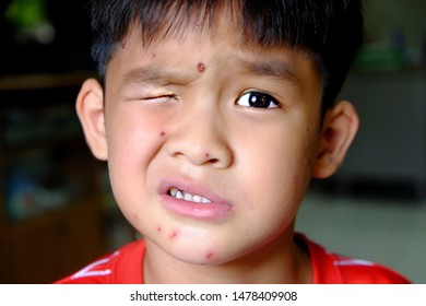 Imágenes Fotos De Stock Y Vectores Sobre Chickenpox Shutterstock