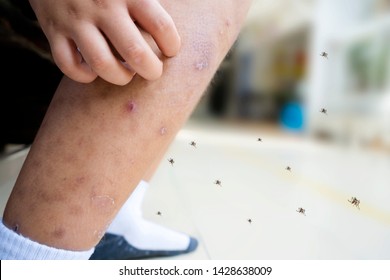 Little Asian Boy Has Allergies With Mosquitoes Bite And Itching Her Leg.Mosquito Sucking Blood On Child Skin. Many Mosquito Bites Hurt And Scars On The Legs. Small Children Sitting In Chairs. 