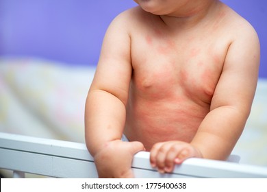 Little Baby With Allergy In Crib At Home