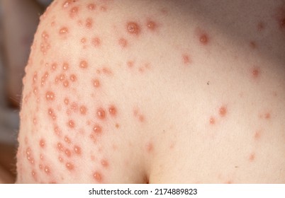 little baby boy with severe form of varicella,chickenpox virus.lot of blisters on child body.nettle rash spread over the all body,most of them in shoulder,neck and hands area.kid lying on bed,fever - Shutterstock ID 2174889823