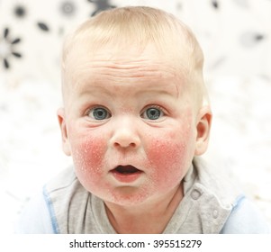 Little Baby With Dermatitis On Face