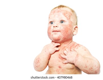 Little Baby With Dermatitis On Face