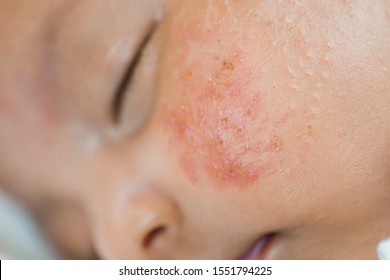 A Little Baby Has A Rash On His Cheek.