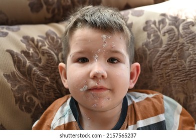 Little Boy With An Allergic Rash On His Face. Kid Boy With Chicken Pox. Mosquito Bites, Roseola, Rubella, Measles