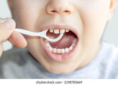 Little Boy Is Cleaning His Teeth With A Toothpick. Plastic Dental Floss.close Up Photo.kid With Diastema Space Between Is Flossing Teeth. Stomatological,dental Care,family Education Healthy