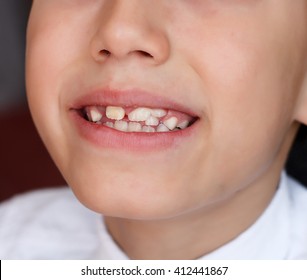 Little Boy With Crooked Teeth