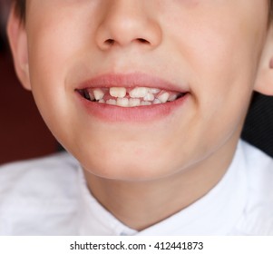 Little Boy With Crooked Teeth