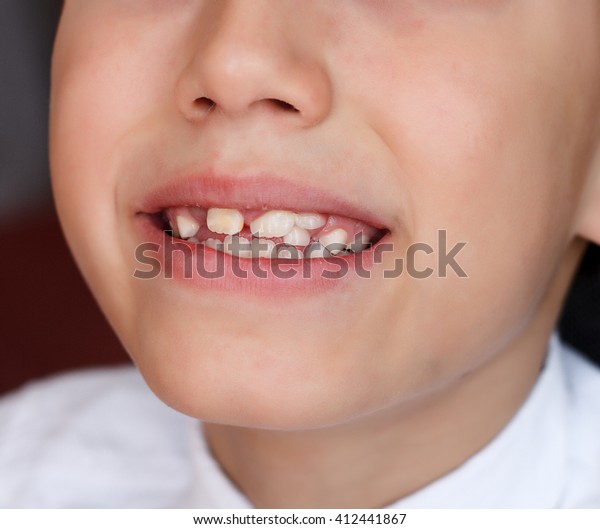 Featured image of post Crooked Teeth Clipart This is from her photoshop portrait retouching advanced techniques