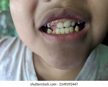 2,423 Child broken tooth Images, Stock Photos & Vectors | Shutterstock