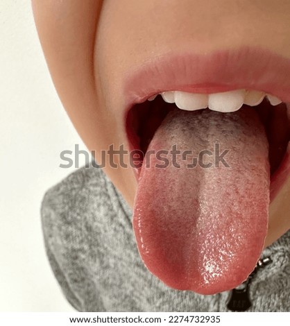 A little boy sticks out his tounge. Kids’ tongue cover with white thick film. White tongue is usually harmless but might cause bad breath.