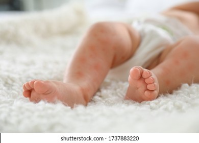 Little Child With Red Rash On Bed, Closeup. Baby Allergies