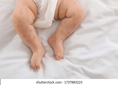 Little Child With Red Rash On Bed, Top View. Baby Allergies