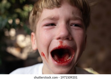 Little Crying Boy Bleeding At Mouth. Child Lips And Face Is Smeared With Blood. First Fight, Split Lip, And Lost Tooth